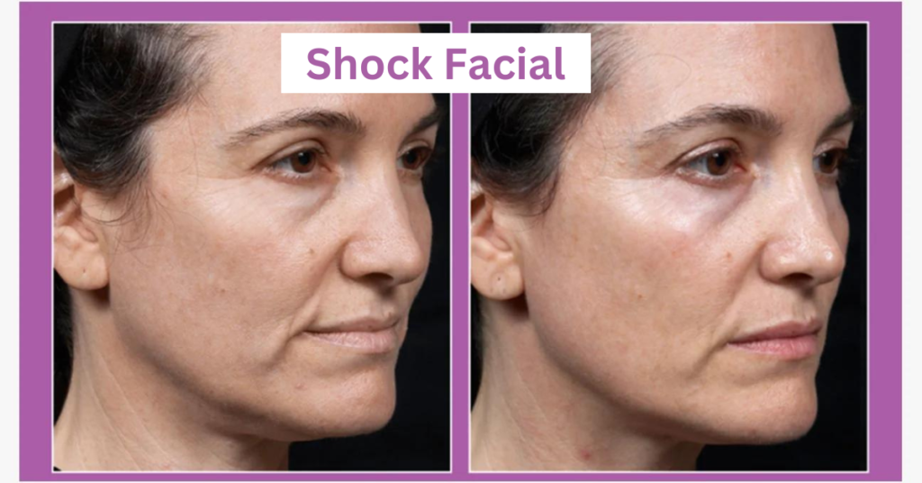 Shock Facial - Unmasking The Science Behind Flawless Skin