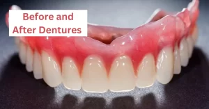 Before and After Dentures- Challenges and Oral Health Impact