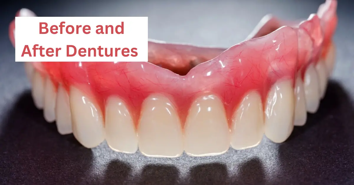 Before and After Dentures Challenges and Oral Health Impact