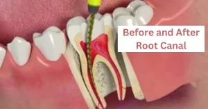 Before and After Root Canal - Complete Guide to Oral Health